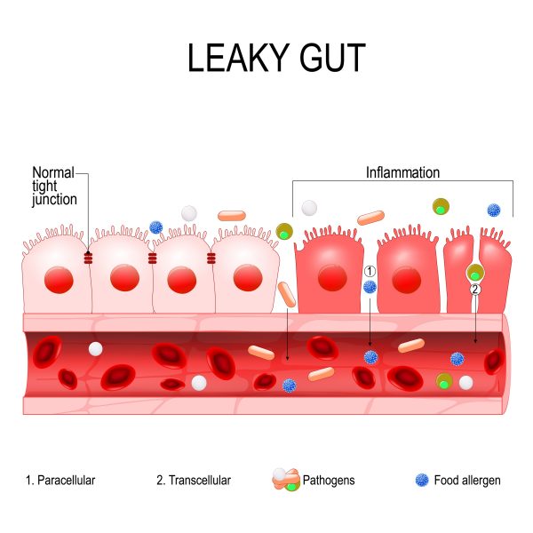 Grafik des Leaky Gut Syndroms, das in der Nährstoffpraxis für einen gesunden Darm behandelt wird